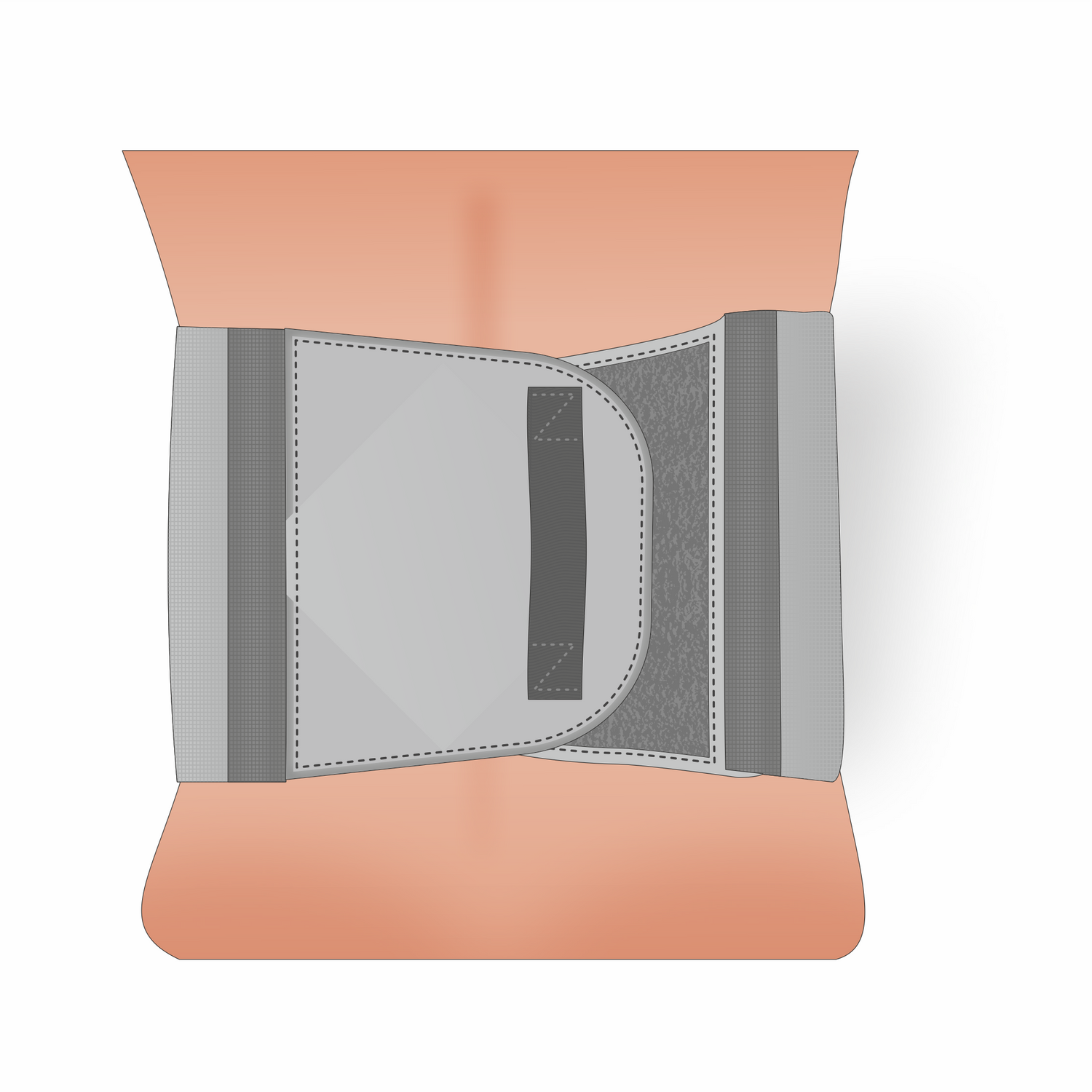 Abdominal Splints