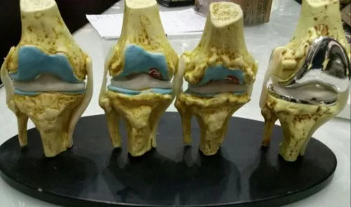 4 Stage Knee Model With Implants