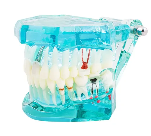 KKI-Transparent Dental Implantation Tooth Model