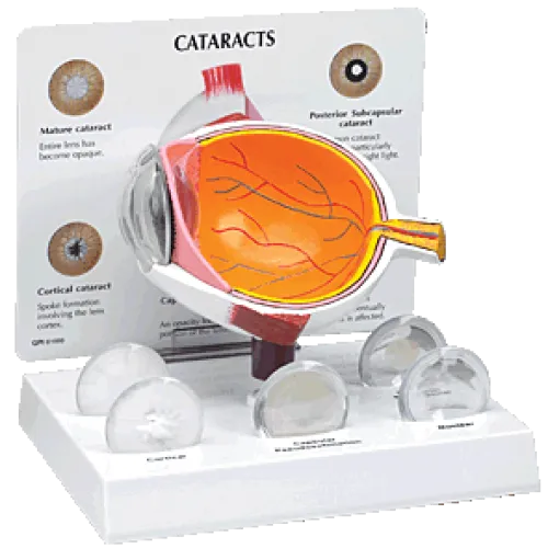 KKI- Cataract Eye Model