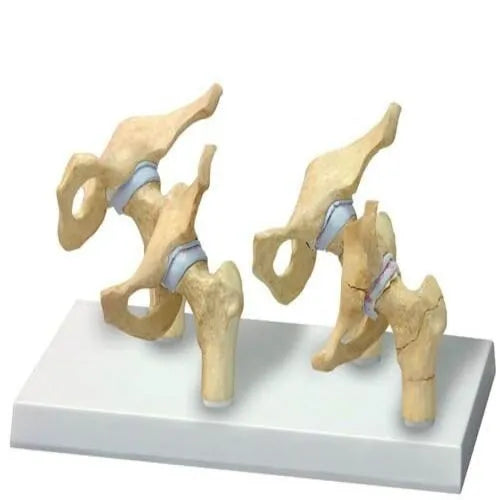 KKI-4 Stages of Osteoarthritis Hip Model