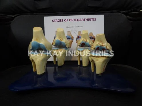 4 Stage Osteoarthritis Model